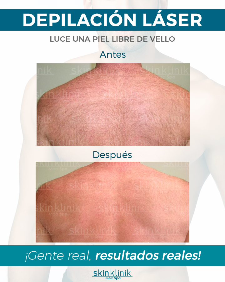 depilacion media espalda